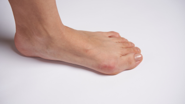 Hallux Valgus – Eine Fehlstellung der Großzehe: Ursachen, Symptome und Informationen